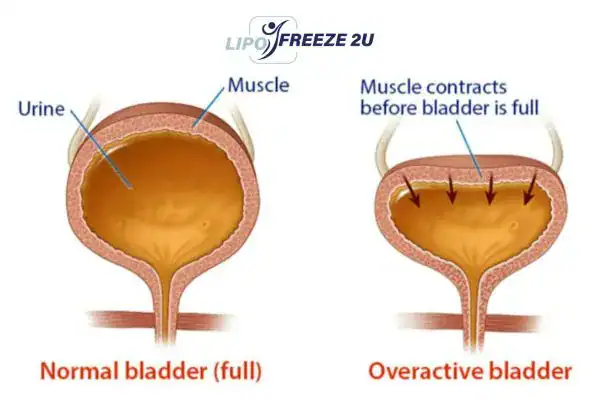 diagram of overactive bladder treatment Worcestershire
