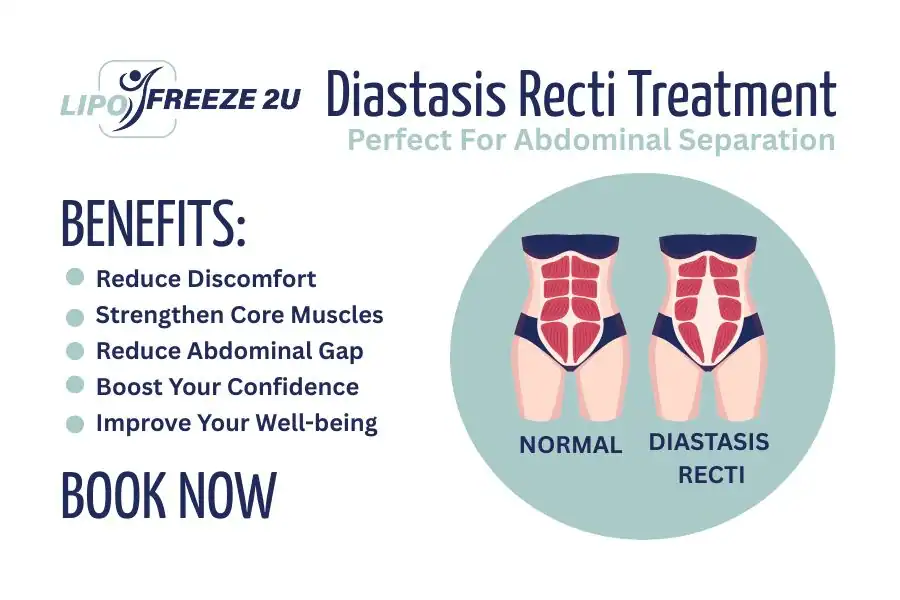 Benefits of body toning treatment Worcestershire for Diastasis recti
