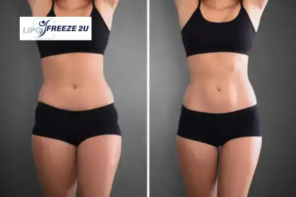 How Can LIPO FREEZE 2U Support Your Post-Pregnancy Body Recovery Worcestershire?