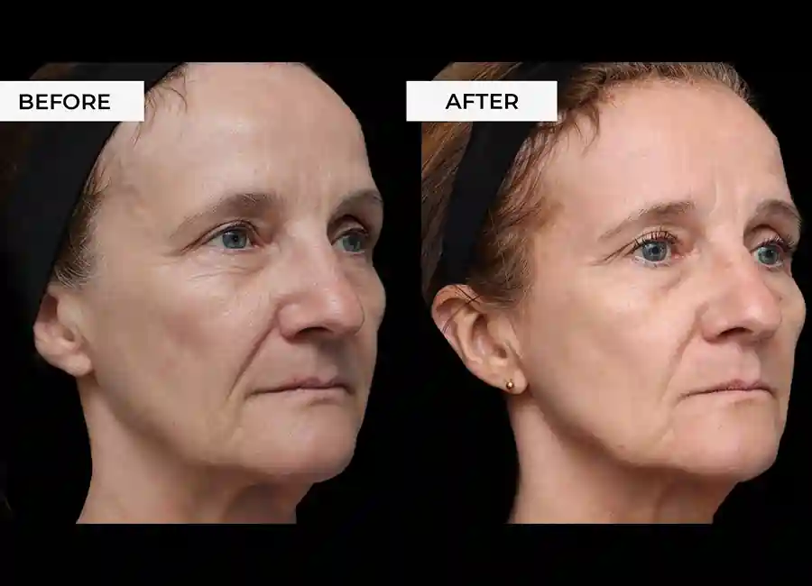 How Many RF Microneedling Sessions Will You Need to See a Difference Worcestershire?