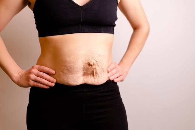 Is Surgery Really the Only Way to Repair Diastasis Recti Worcestershire?